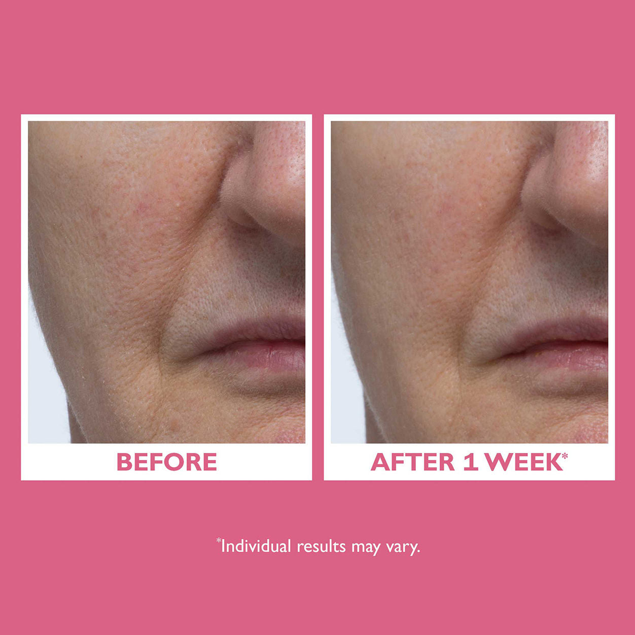 Before and after results of using Peter Thomas Roth Vital-E Microbiome Age Defense Cream