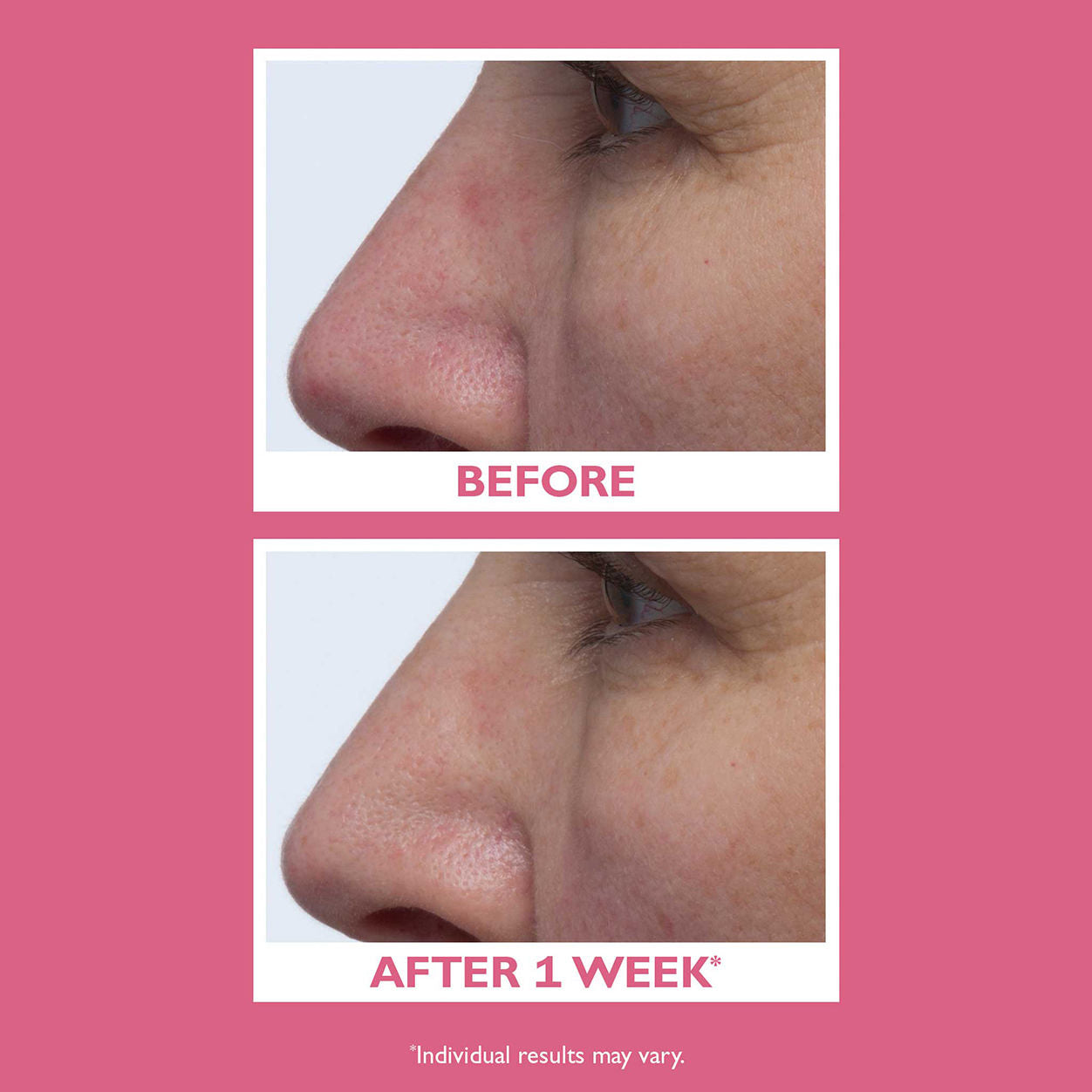 Before and after results of using Peter Thomas Roth Vital-E Microbiome Age Defense Cream