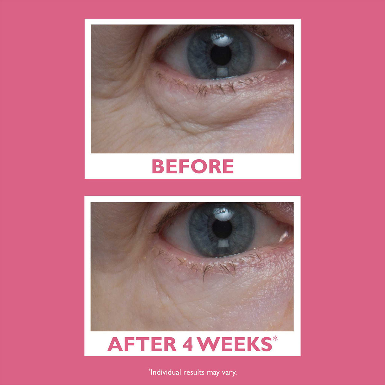 Before and after results of using Peter Thomas Roth Vital-E Microbiome Age Defense Eye Cream
