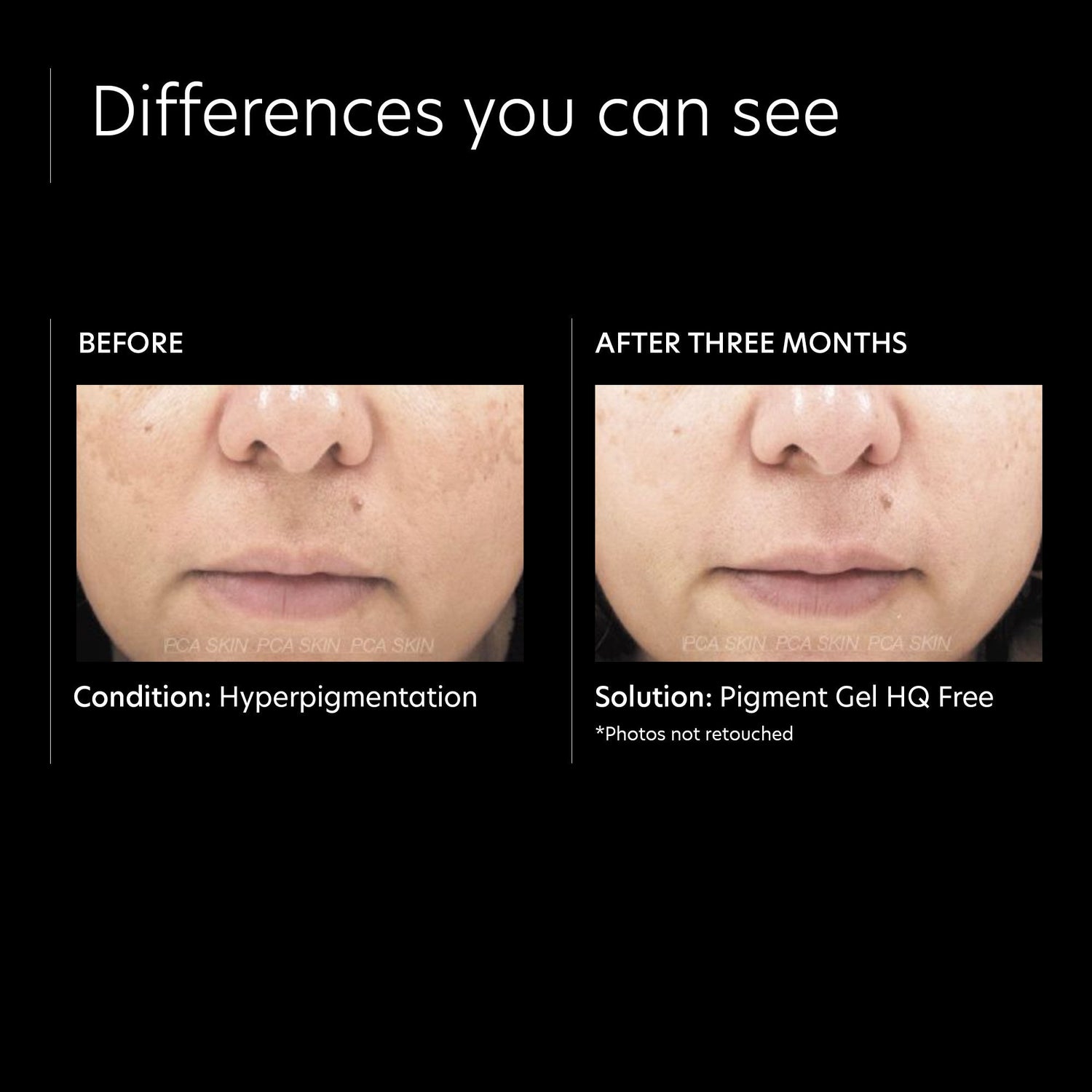 Before and after results of using PCA Skin Pigment Gel HQ Free