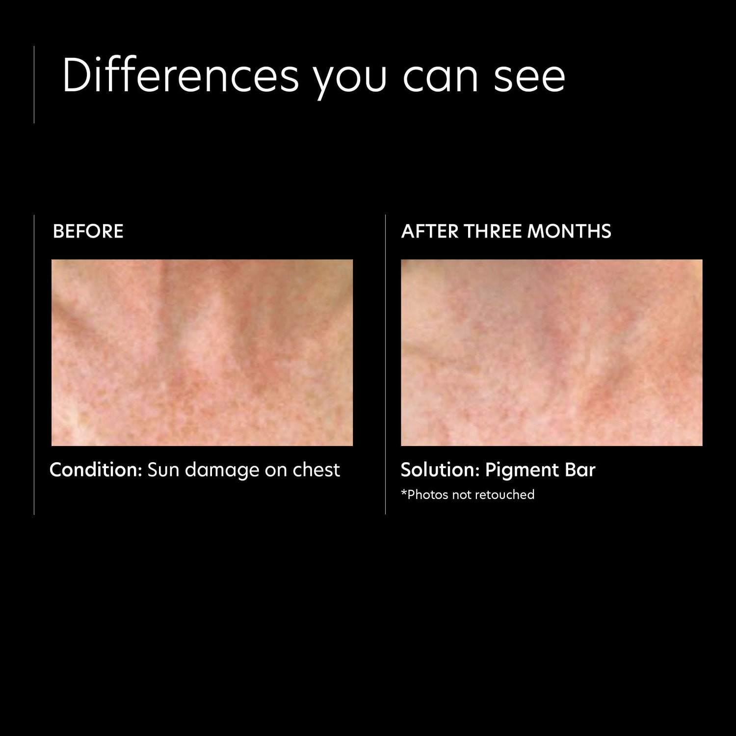 Before and after results of using PCA Skin Pigment Bar