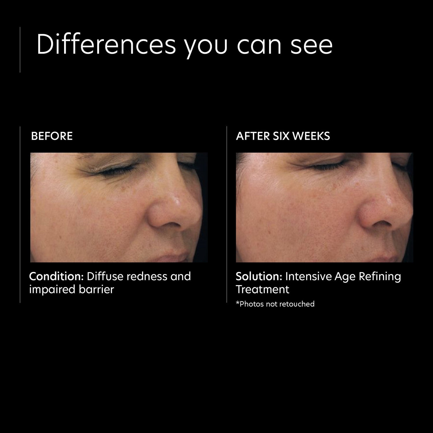 Before and after results of using PCA Skin Intensive Age Refining Treatment