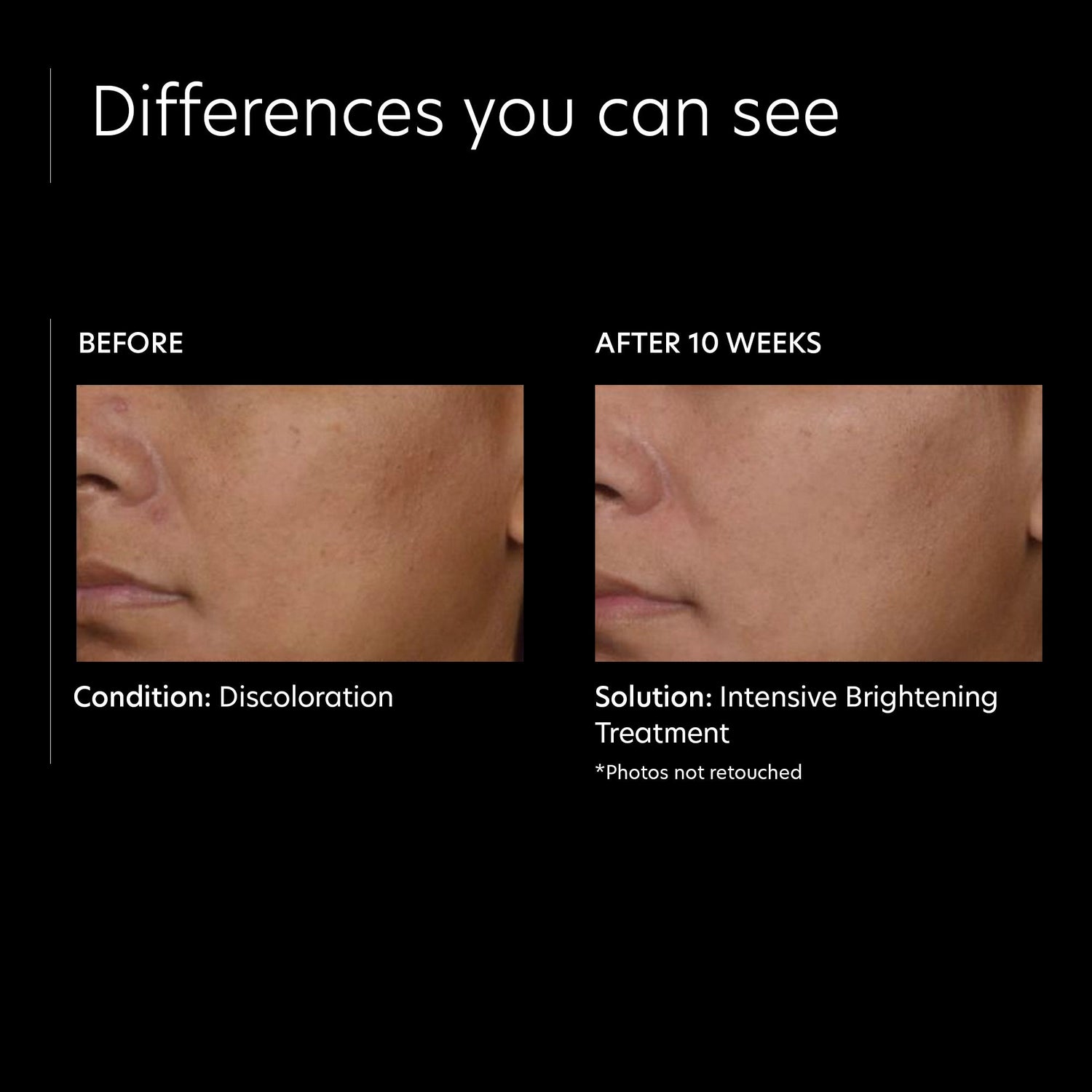 Before and after results of using PCA Skin Intensive Brightening Treatment