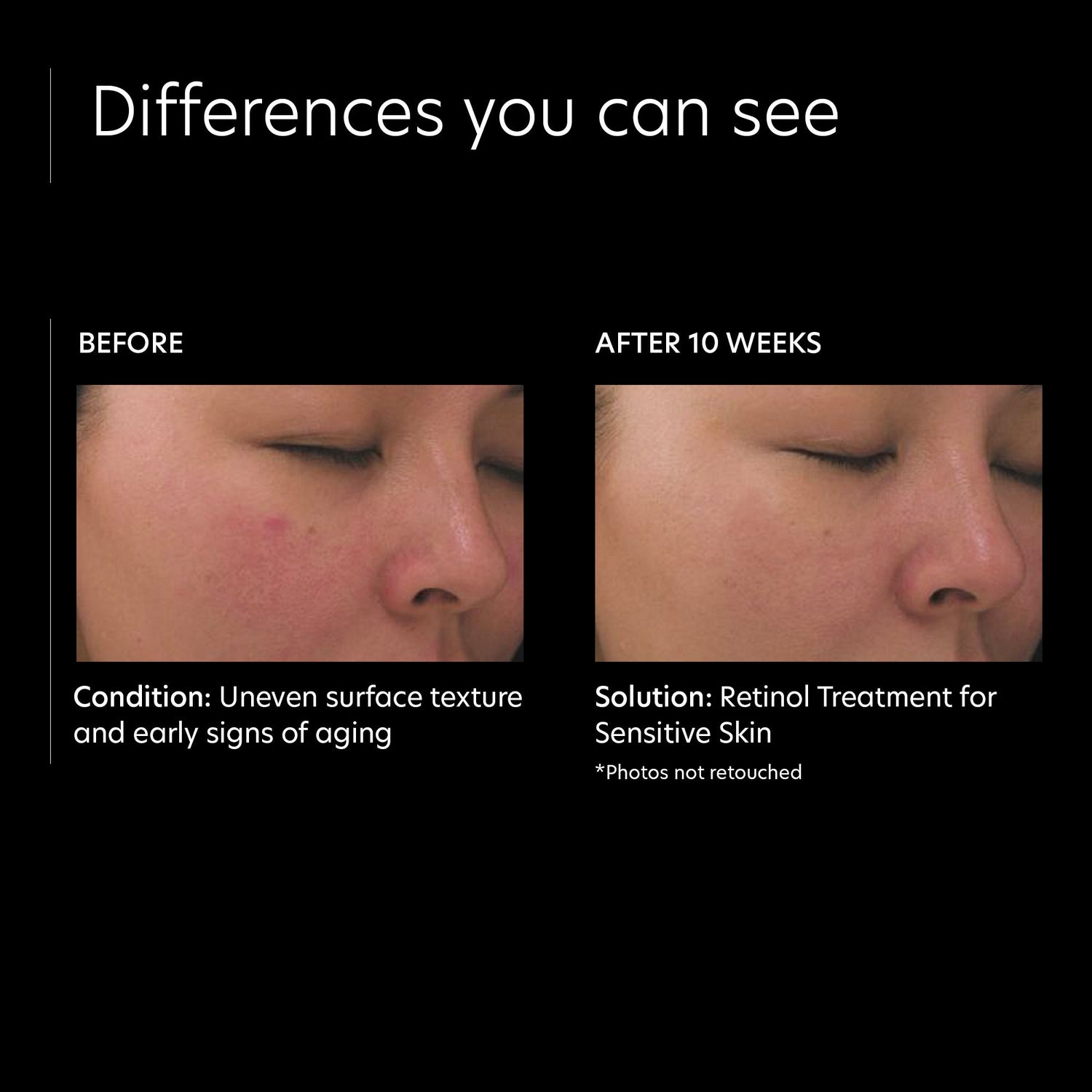 Before and after results of using PCA Skin Retinol Treatment for Sensitive Skin