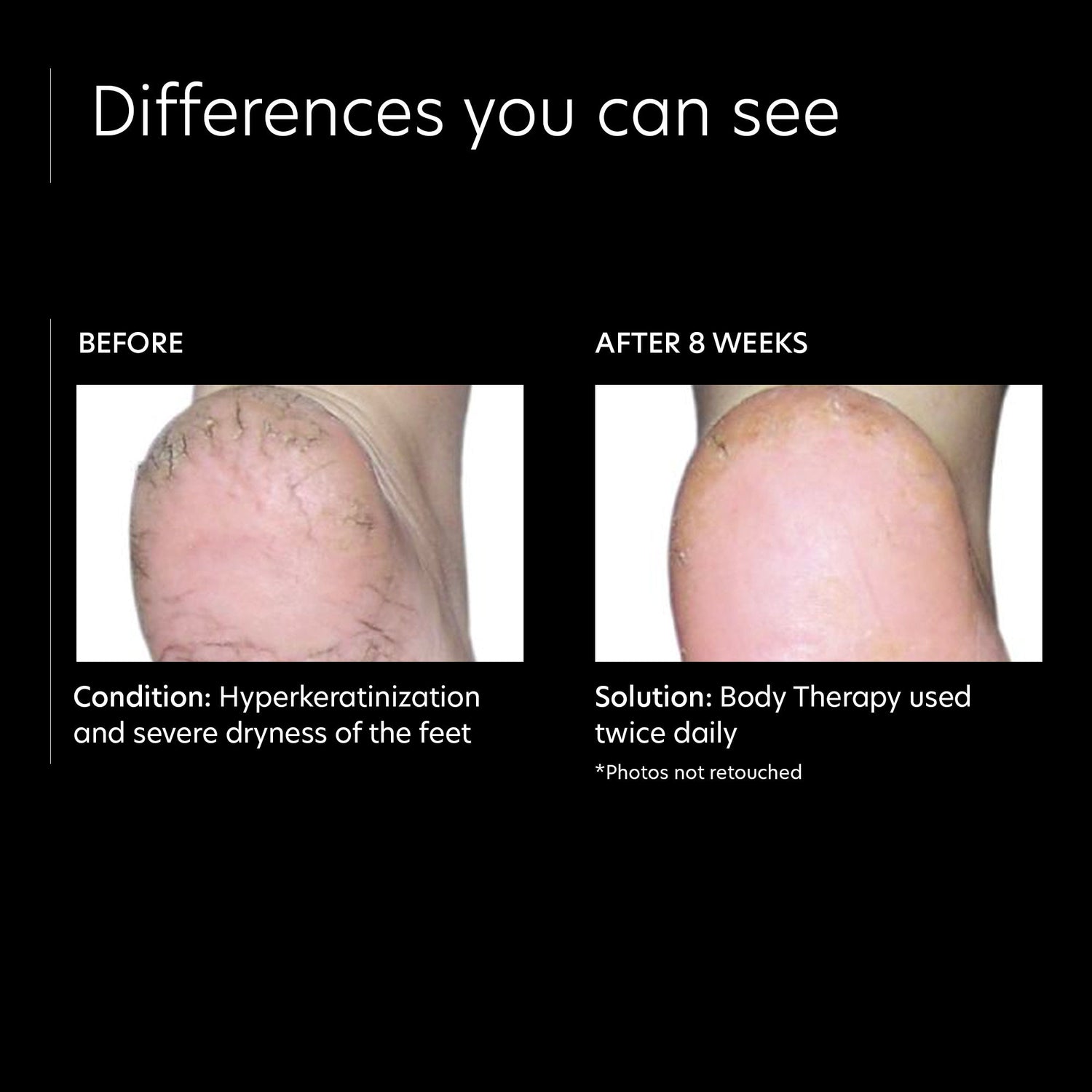 Before and after results of using PCA Skin Body Therapy