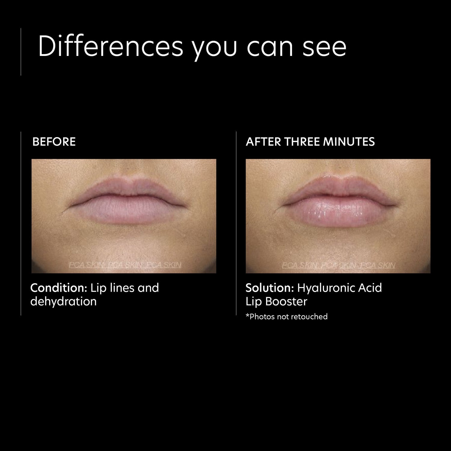 Before and after results of using PCA Skin Hyaluronic Acid Lip Booster