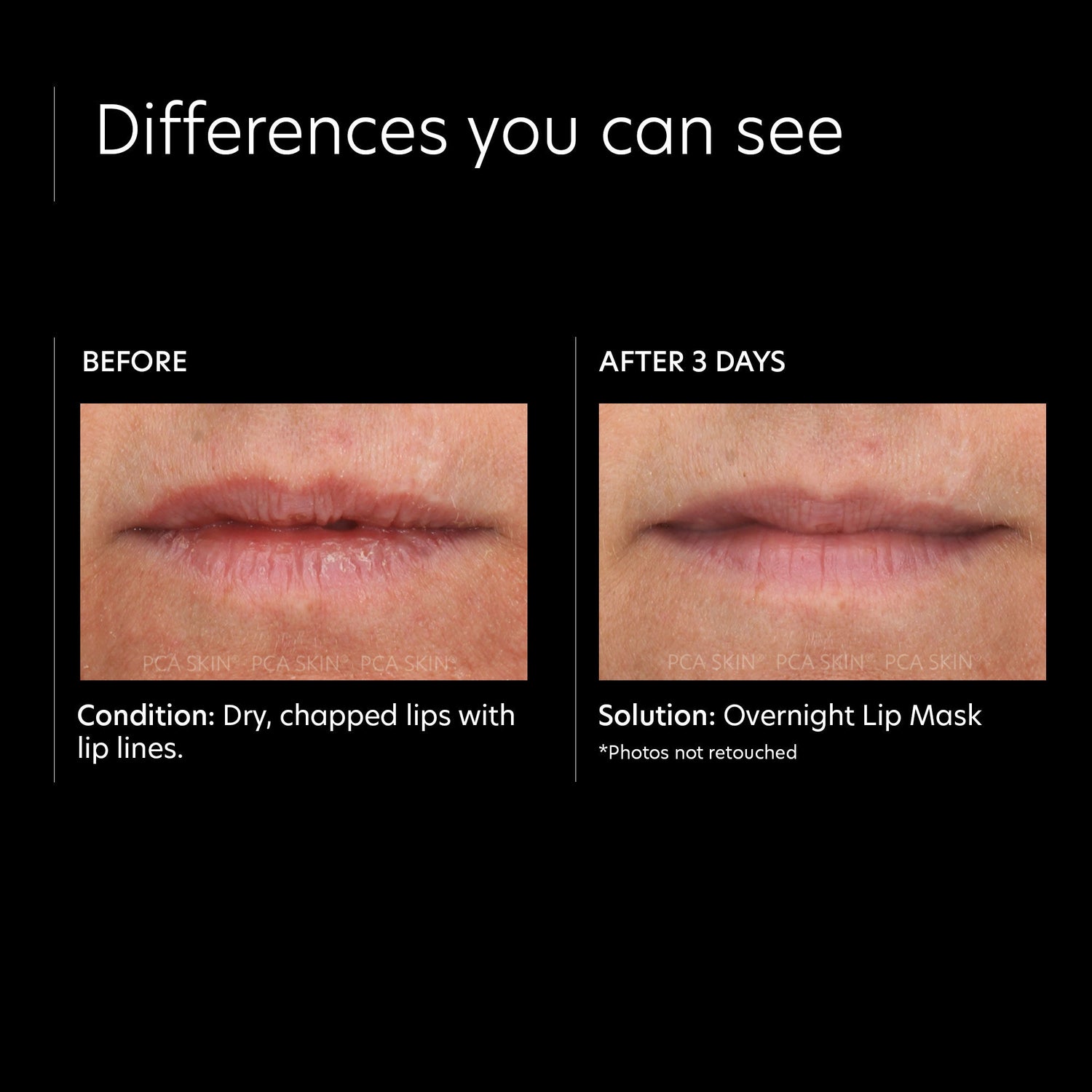 Before and after results of using PCA Skin Overnight Lip Mask
