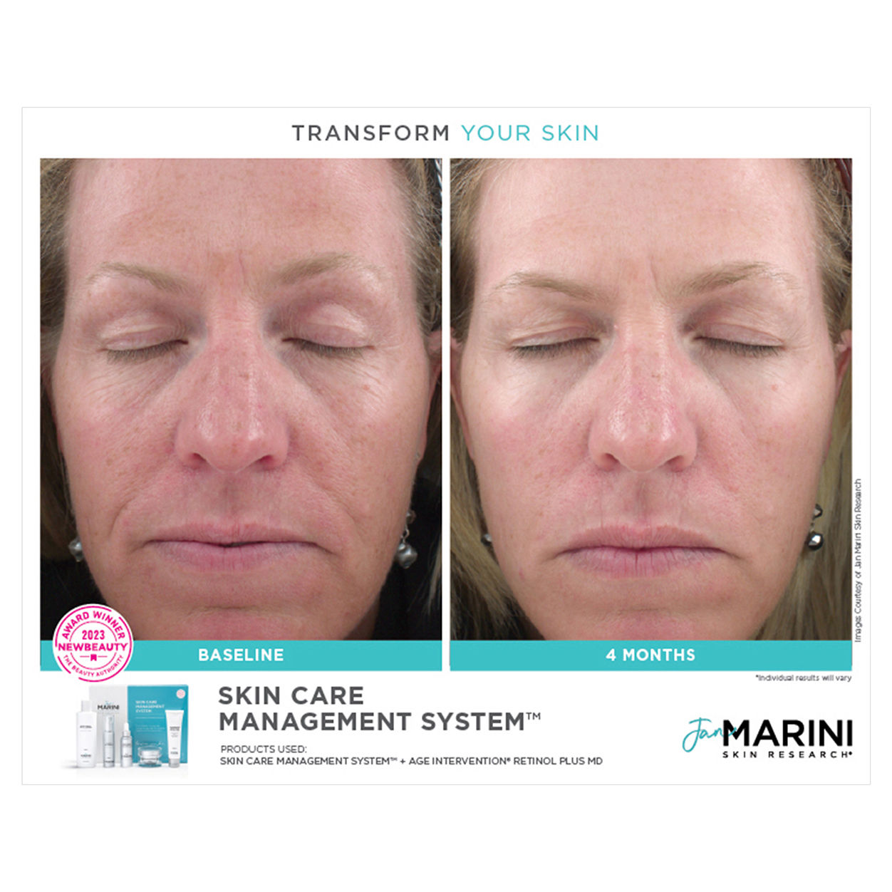 Before and after results of using Jan Marini Skin Care Management System Normal or Combination Skin with Antioxidant Daily Face Protectant SPF 33
