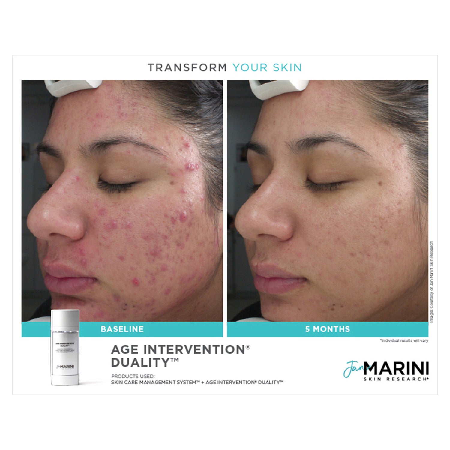 Jan Marini Age Intervention Duality before and after image .