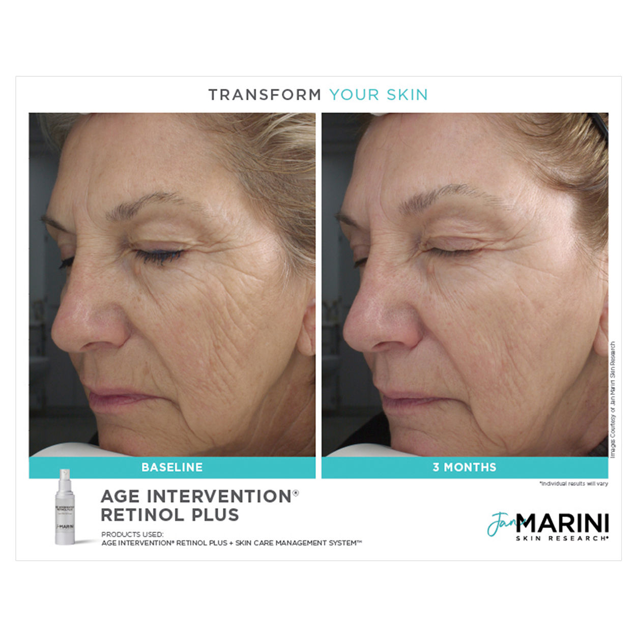 Before and after results of using Jan Marini Age Intervention Retinol Plus
