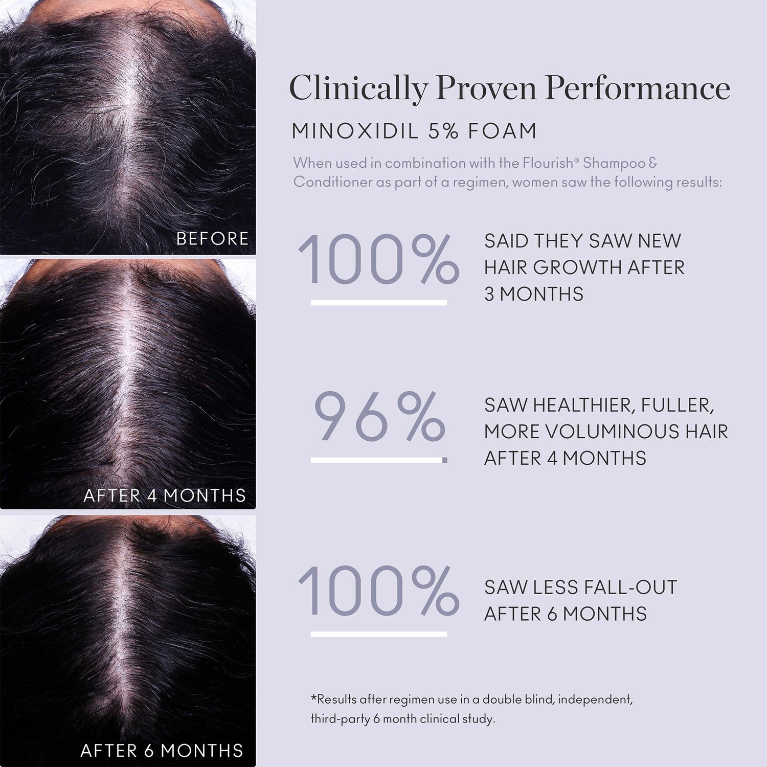 Before and after results of using Virtue Flourish Minoxidil Foam – Single Canister