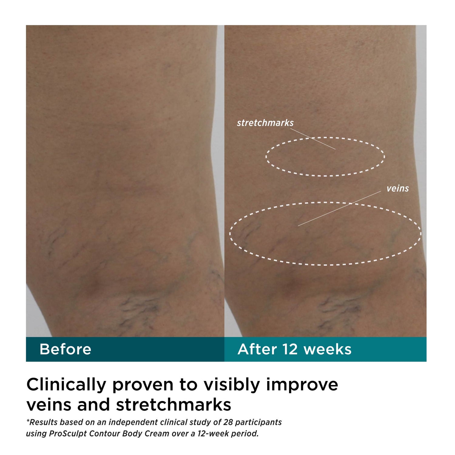 Before and after results of using M-61 ProSculpt Contour Body Cream