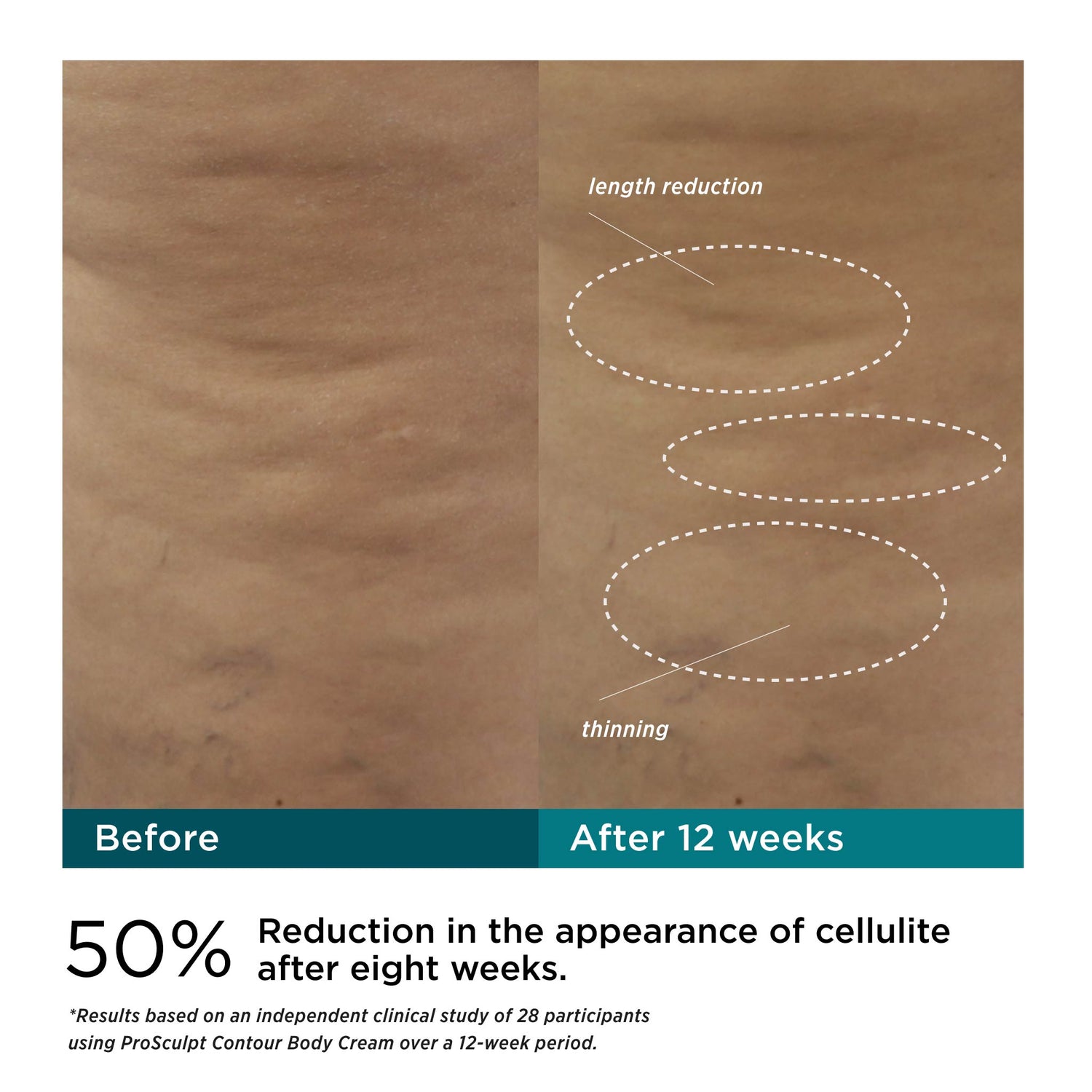 Before and after results of using M-61 ProSculpt Contour Body Cream with AFT3™