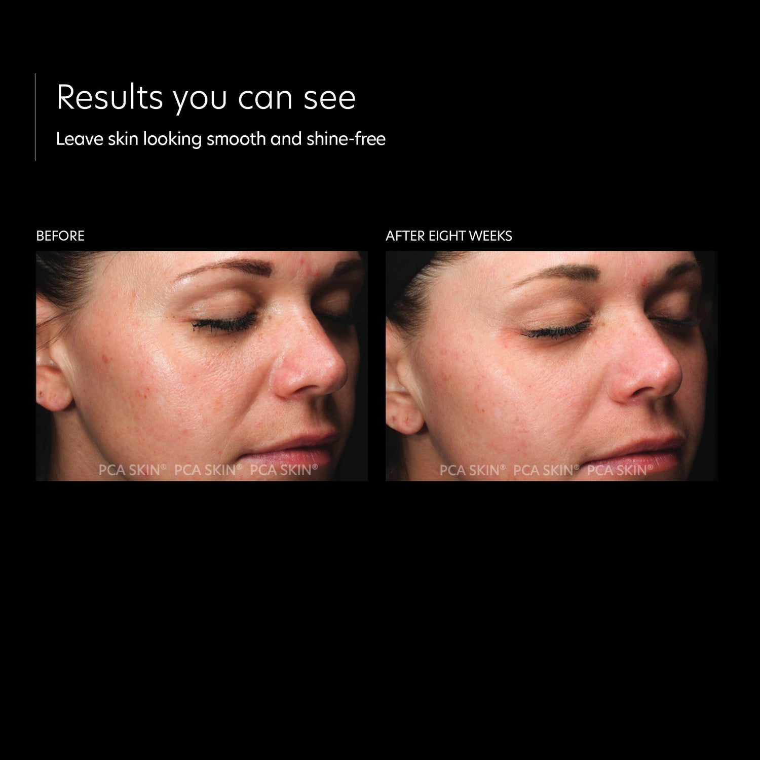 Before and after results of using PCA Skin HydraMatte