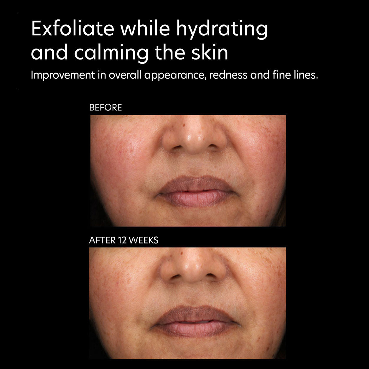 Before and after results of using PCA Skin Resurfacing Serum