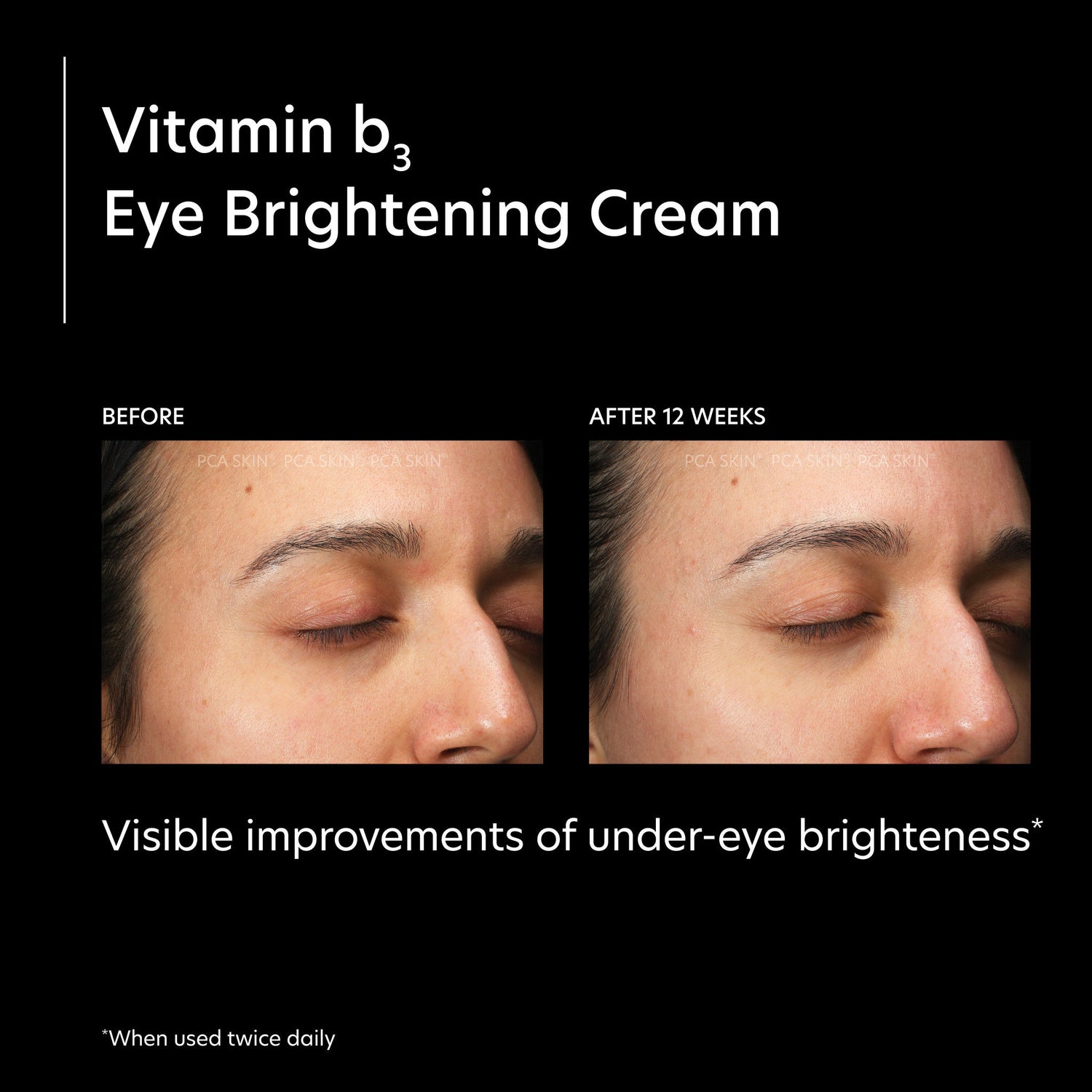 Before and after results of using PCA Skin Vitamin B3 Eye Brightening Cream