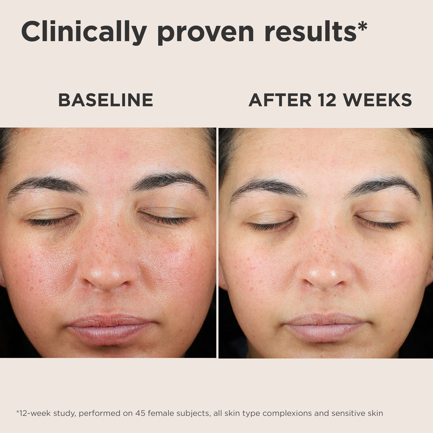 Before and after results of using EltaMD UV Skin Recovery Broad Spectrum SPF 50