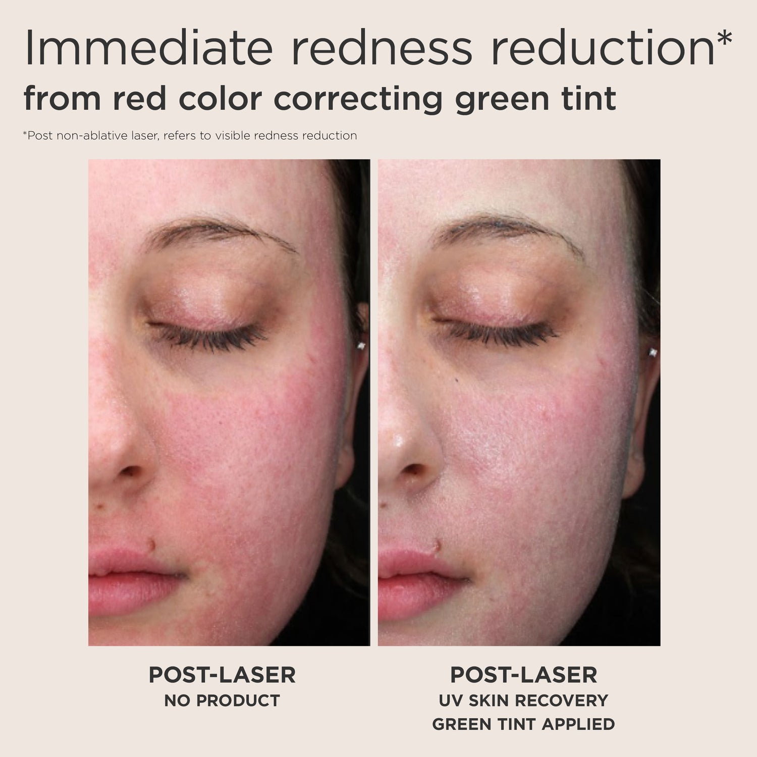Before and after results of using EltaMD UV Skin Recovery Red Color Correcting Green Tint Broad Spectrum SPF 50