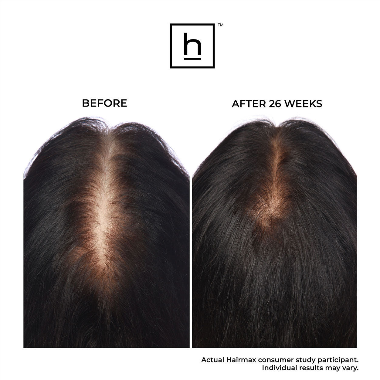 Before and after results of using HairMax LaserBand 82 ComfortFlex