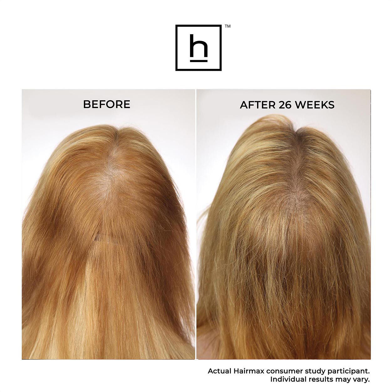 Before and after results of using HairMax LaserBand 82 ComfortFlex