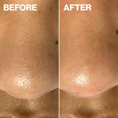 Before and after results of using Dermaflash Dermapore+ Blush