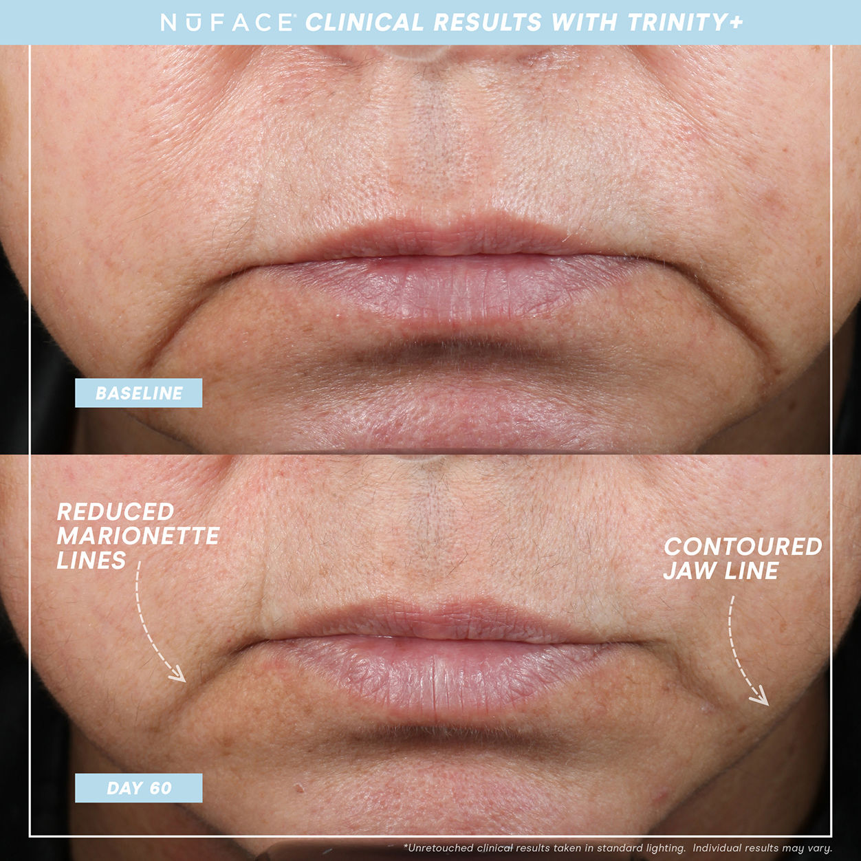 Before and after results of using NuFace Trinity+ and Effective Lip and Eye Attachment