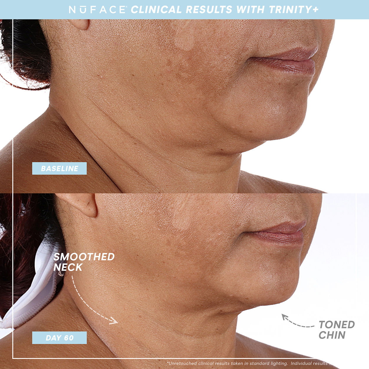 Before and after results of using NuFace Trinity+ and Effective Lip and Eye Attachment