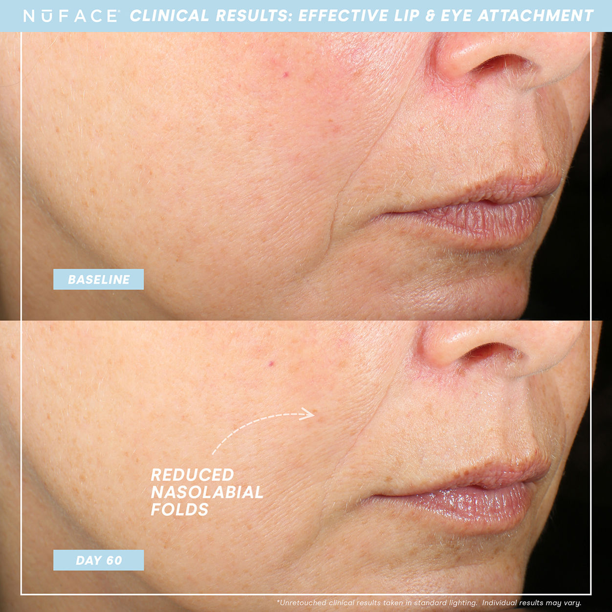 Before and after results of using NuFace Trinity+ and Effective Lip and Eye Attachment