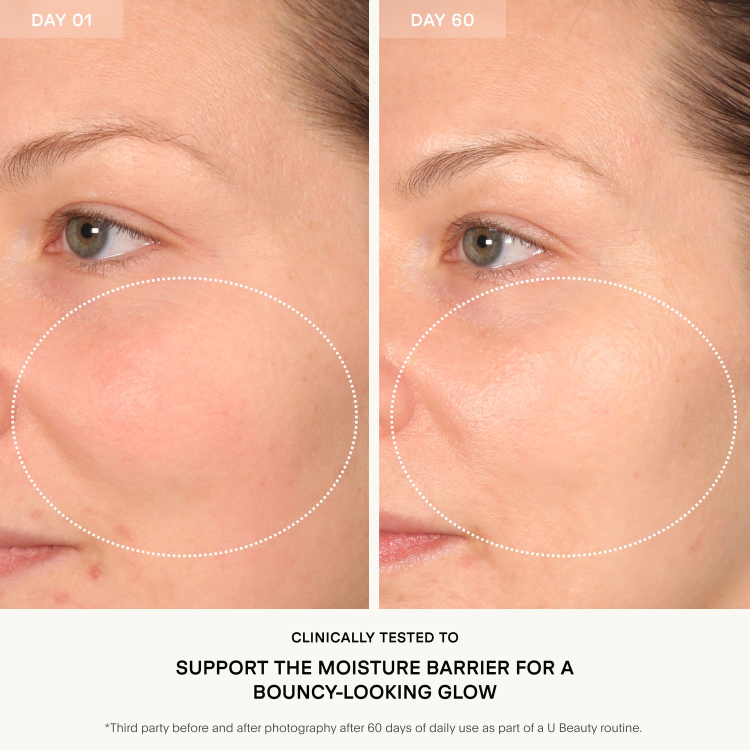 Before and after results of using U Beauty The Barrier Bioactive Treatment