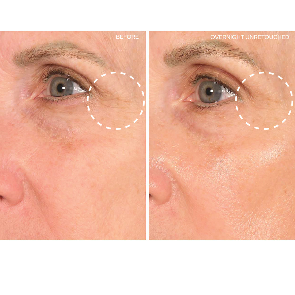 Before and after results of using SIO Super EyeLift
