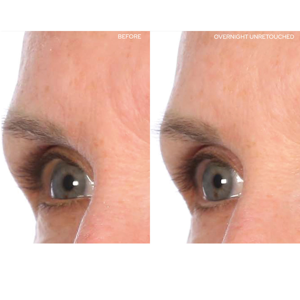 Before and after results of using SIO BrowLift