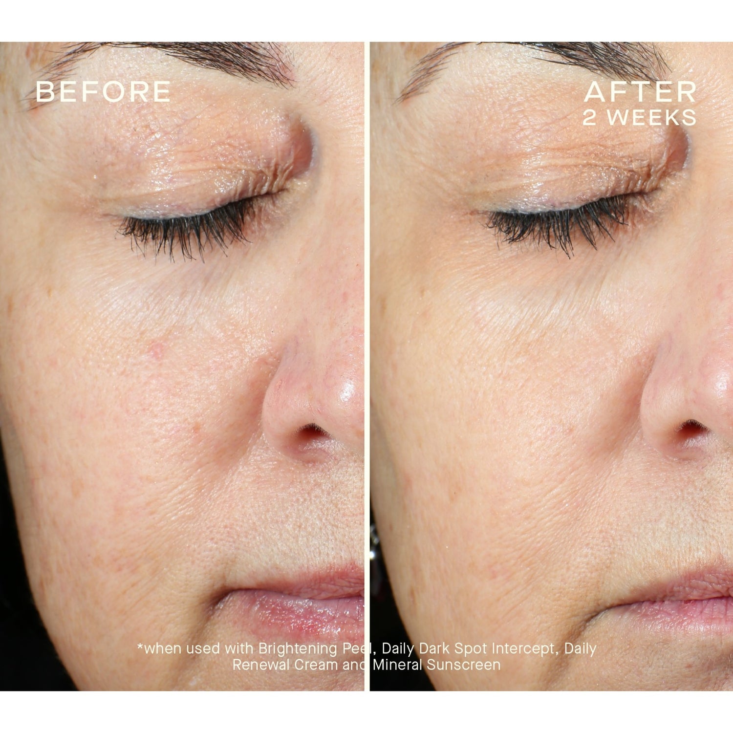 Ourself Brightening Peel Kit before and after image 2 .