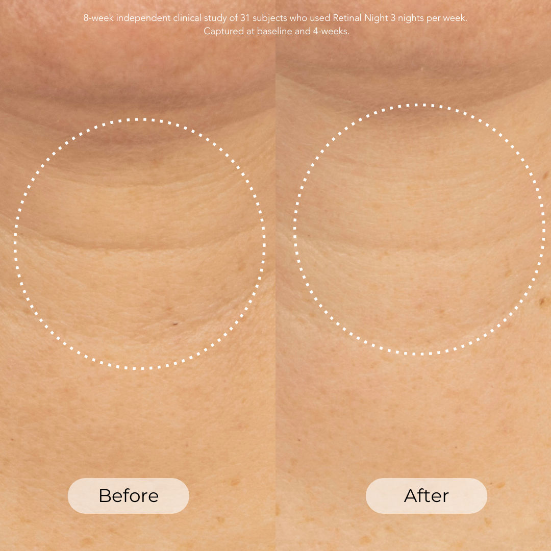 Before and after results of using Dr. Whitney Bowe Beauty Skin Cycling Program