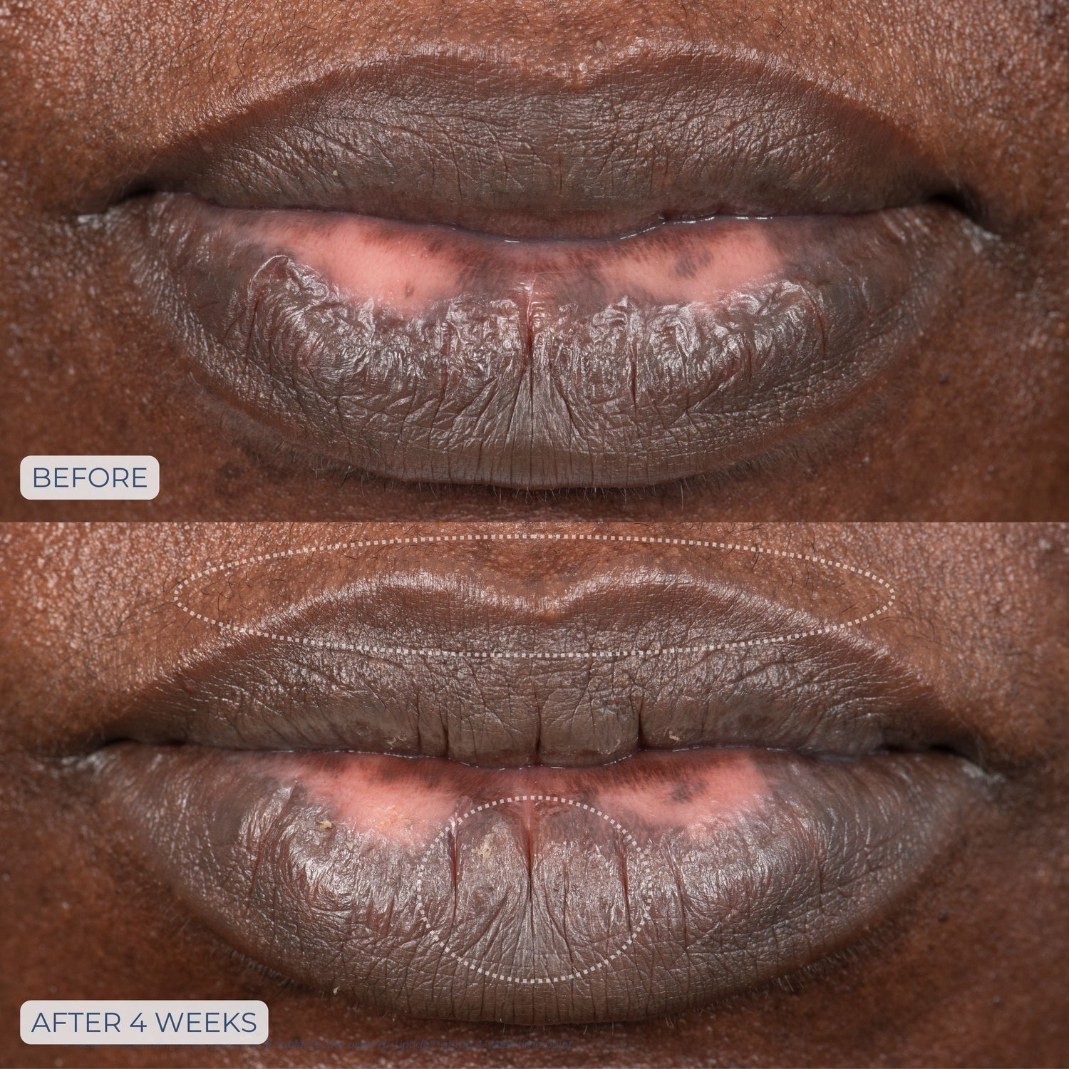 Before and after results of using Dr. Whitney Bowe Beauty Tri-Liptide Peptide Lip Enhancing Treatment