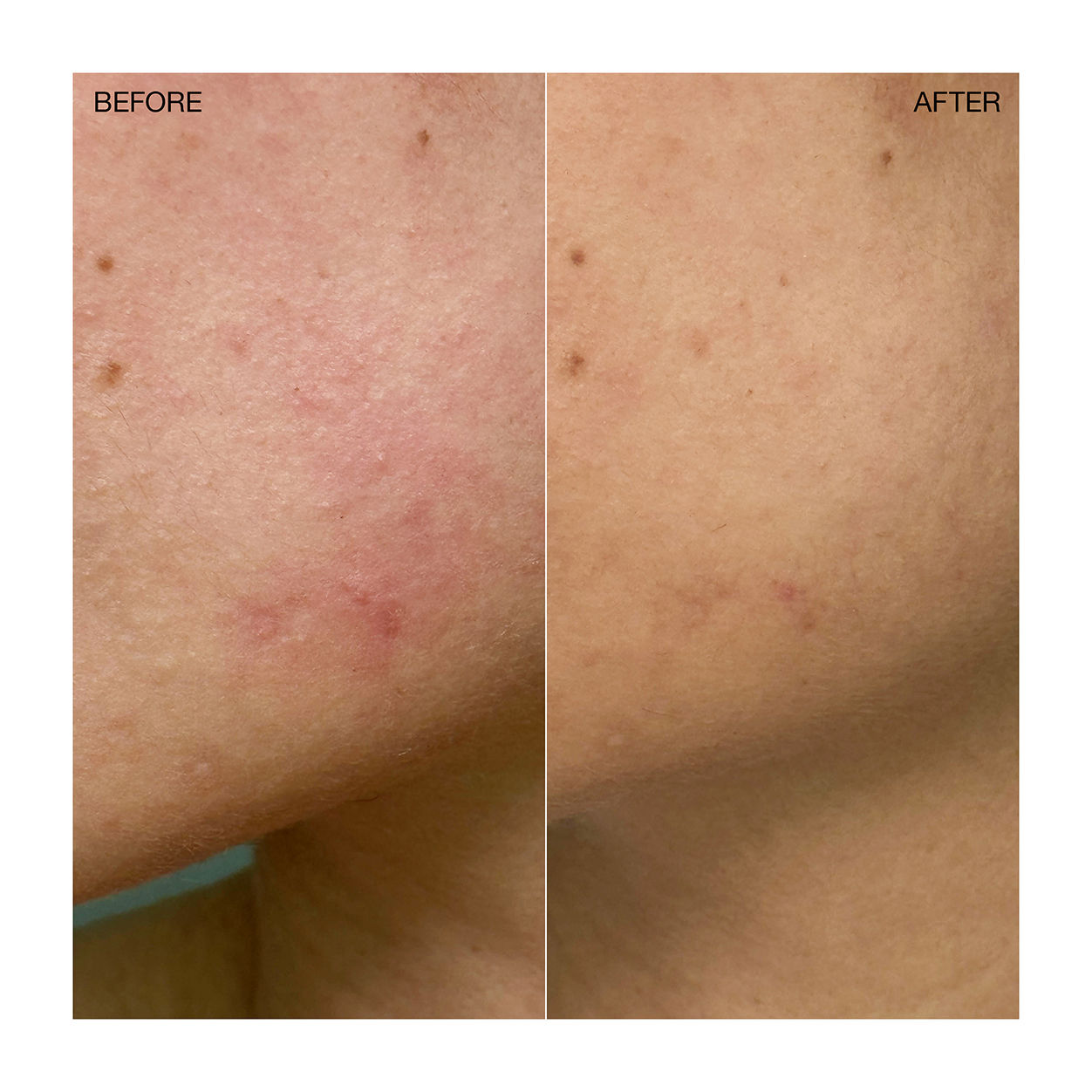 Before and after results of using Ogee Targeted Blemish Treatment