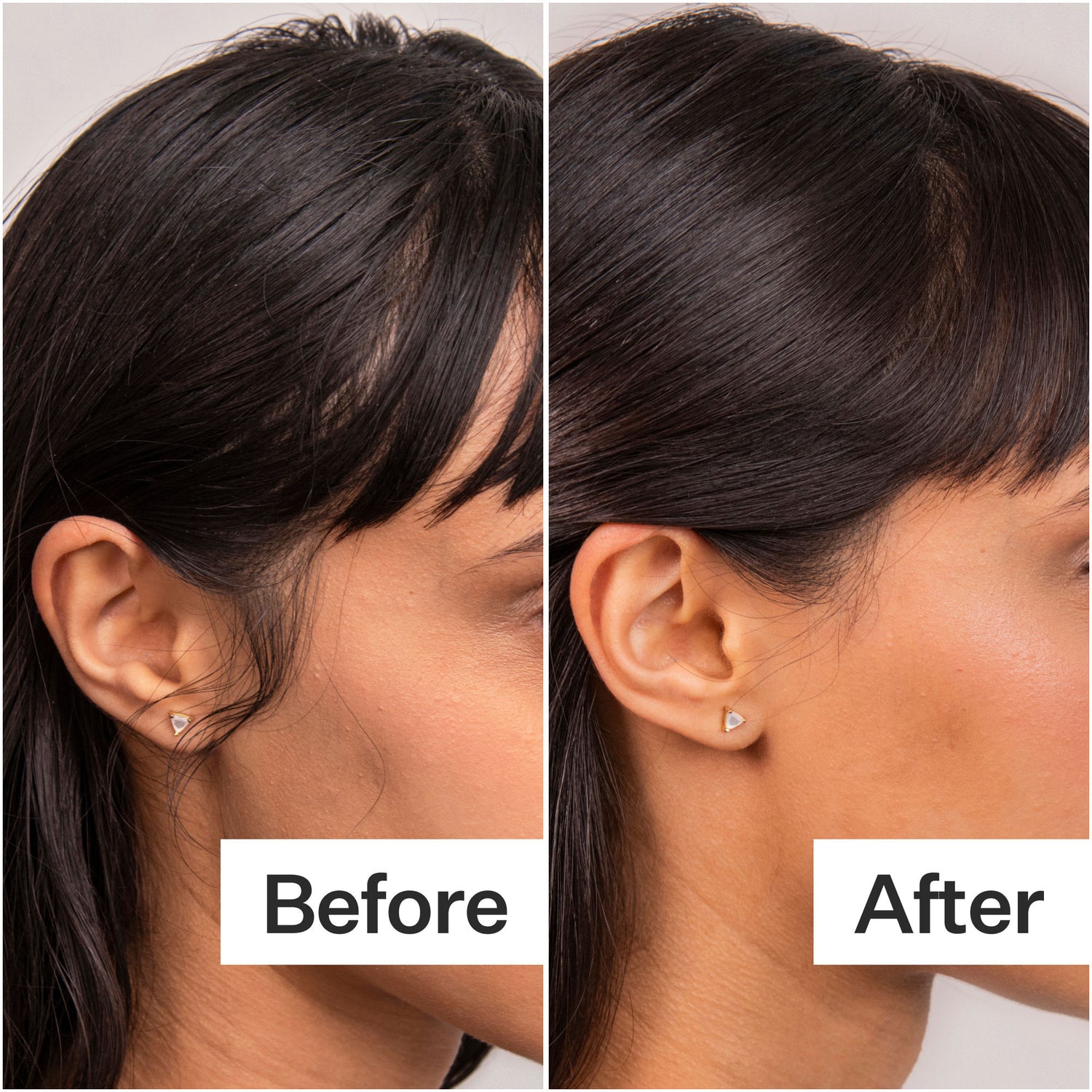 Before and after results of using Act+Acre 4% Niacinamide Oily Scalp Serum
