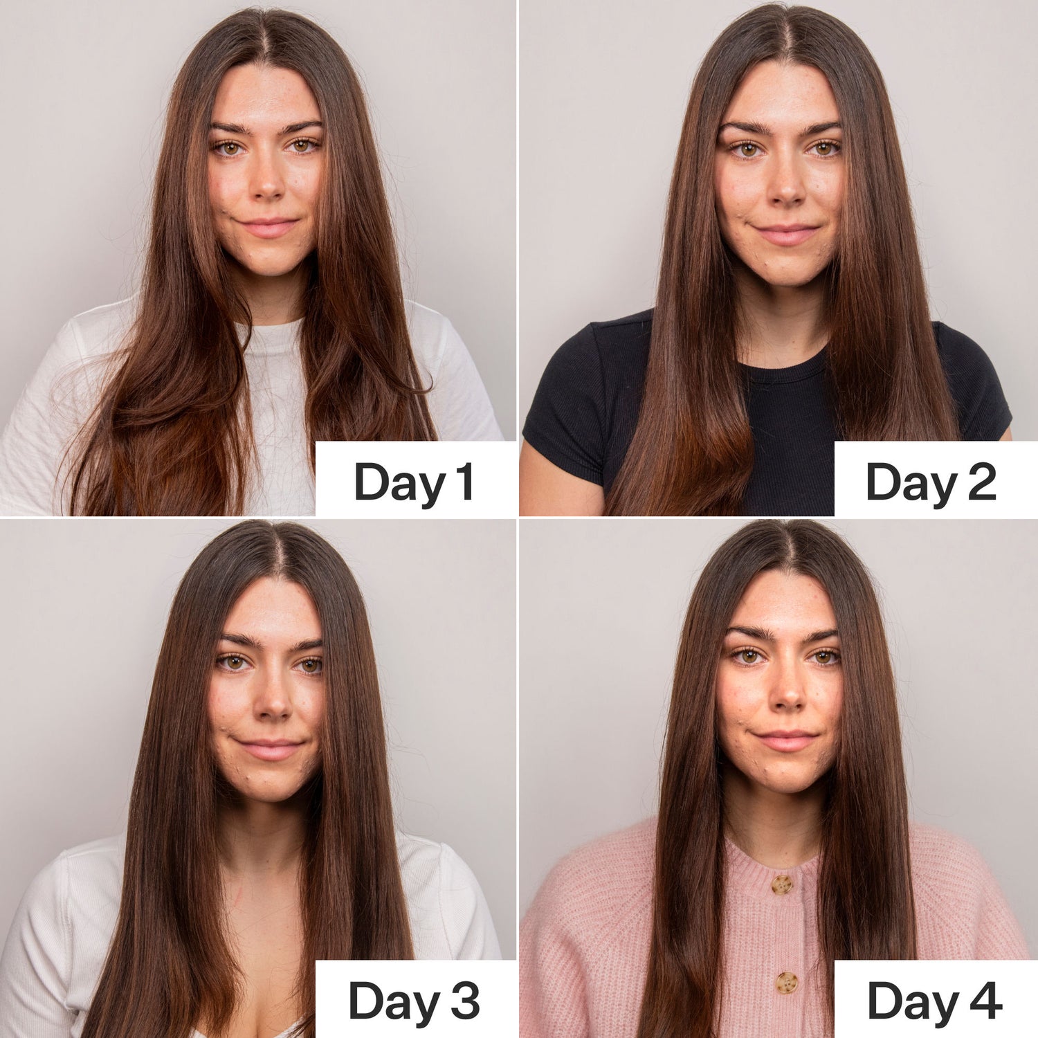 Before and after results of using Act+Acre 4% Niacinamide Oily Scalp Serum