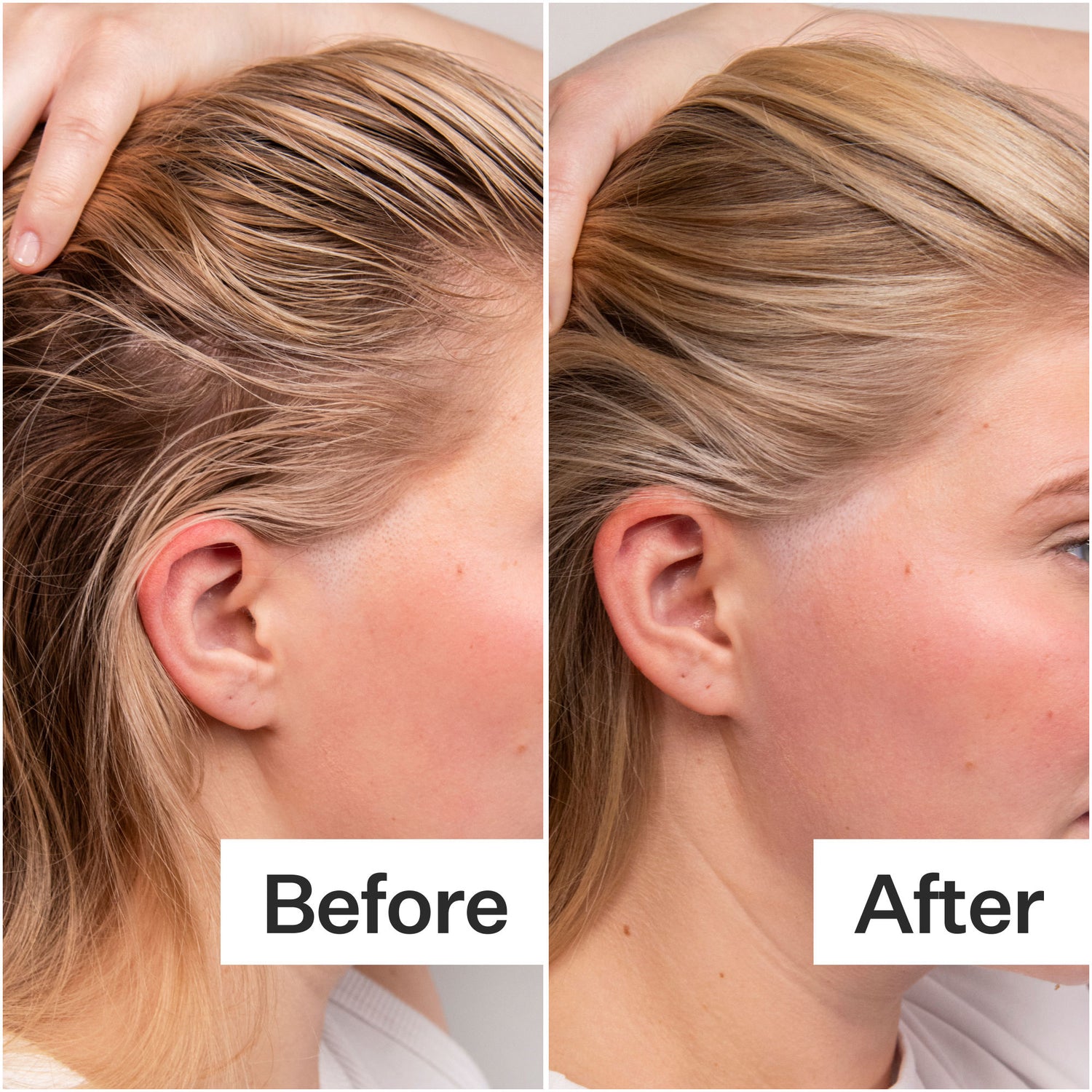 Before and after results of using Act+Acre 4% Niacinamide Oily Scalp Serum
