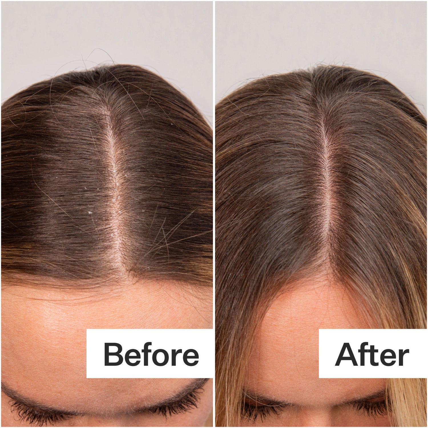 Before and after results of using Act+Acre Daily Hydro Scalp Serum with Hyaluronic Acid for Dry Scalp