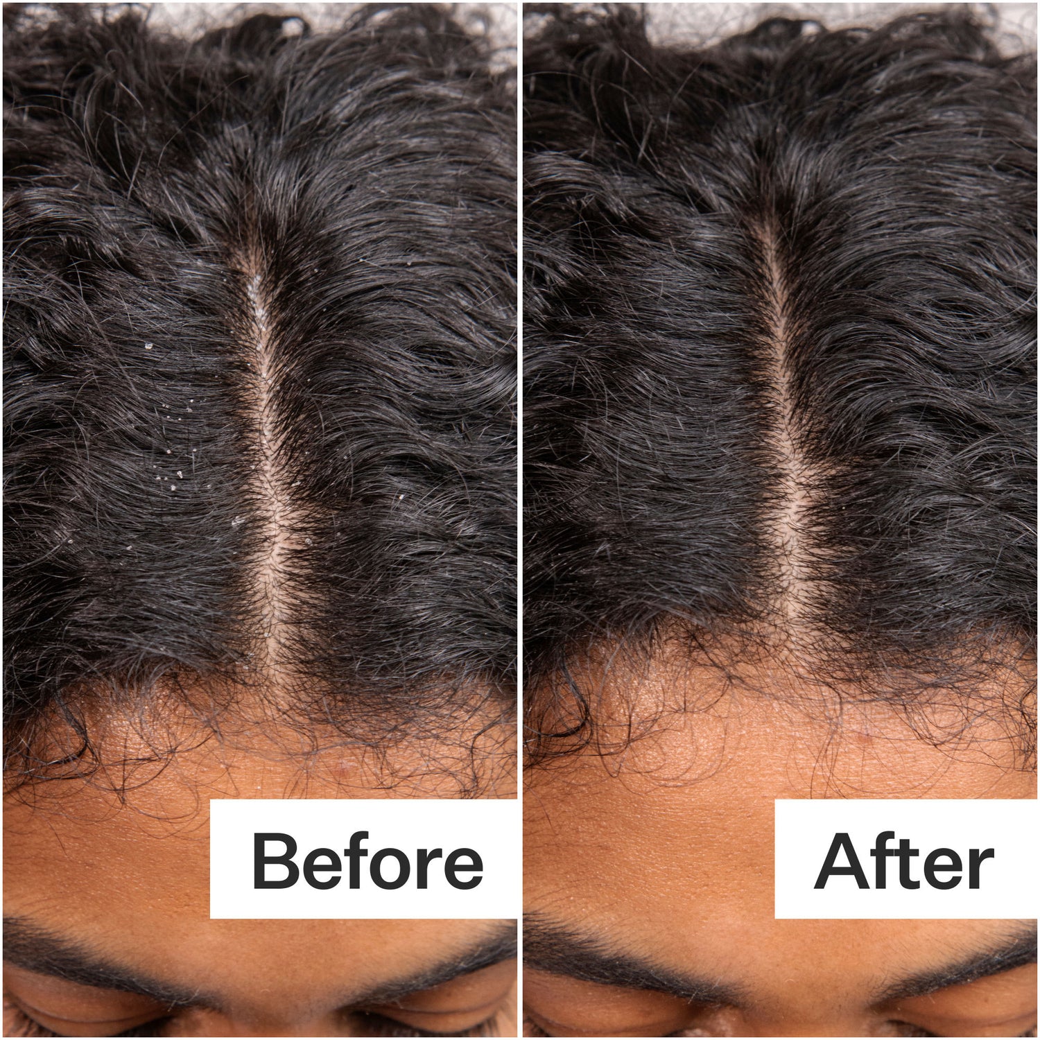 Before and after results of using Act+Acre Daily Hydro Scalp Serum with Hyaluronic Acid for Dry Scalp
