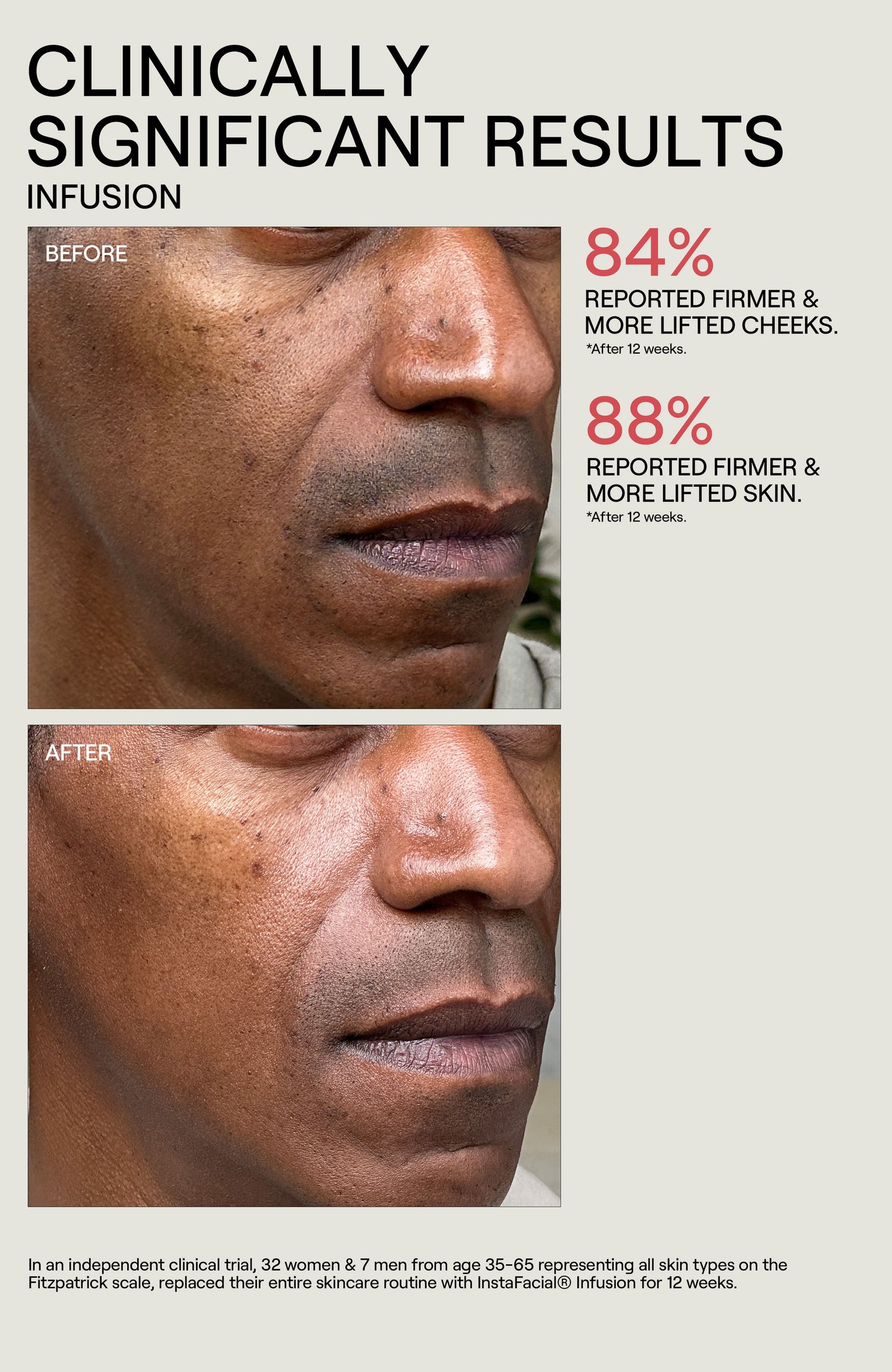 Before and after results of using Dr. Diamond’s Metacine InstaFacial Collection Set