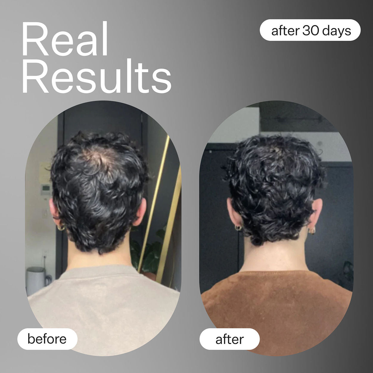 Before and after results of using Act+Acre Cold Processed Plant Based Hair Capsules