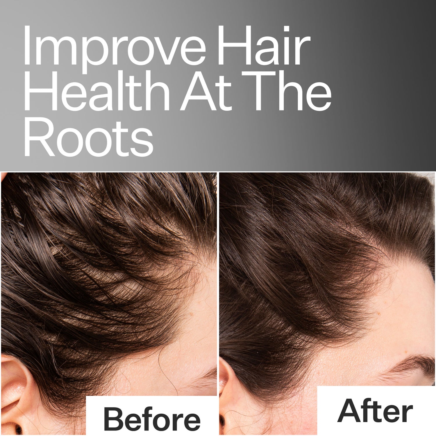 Before and after results of using Act+Acre Scalp Relief System