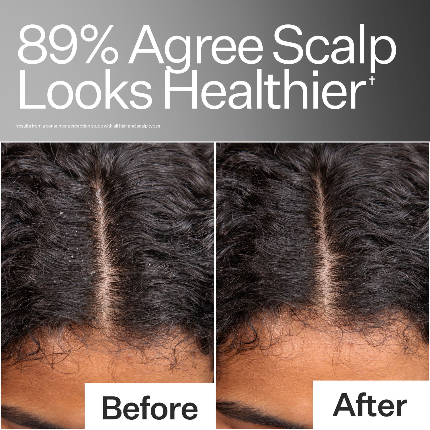 Before and after results of using Act+Acre Scalp Relief System