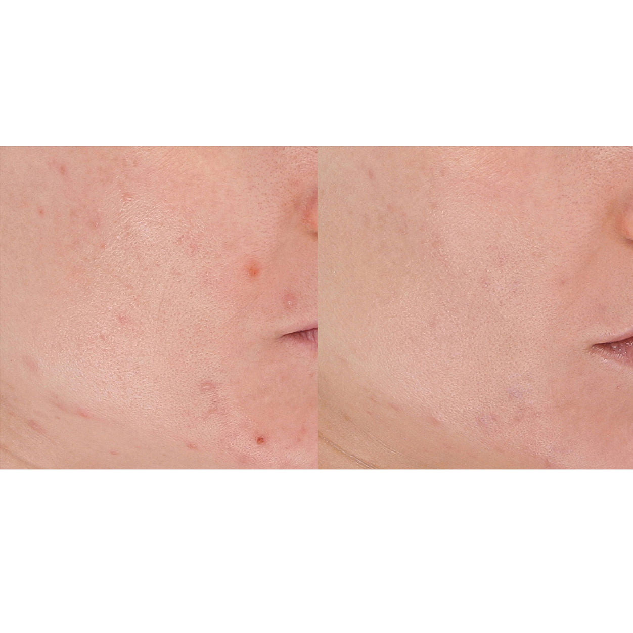 Model image of LightStim LightStim for Acne