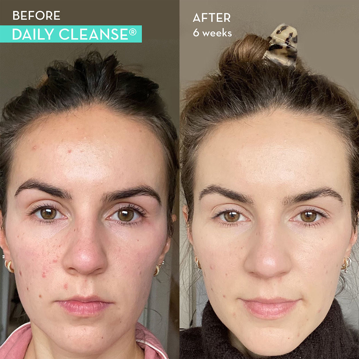 Before and after results of using Hum Daily Cleanse Clear Skin and Acne Supplement