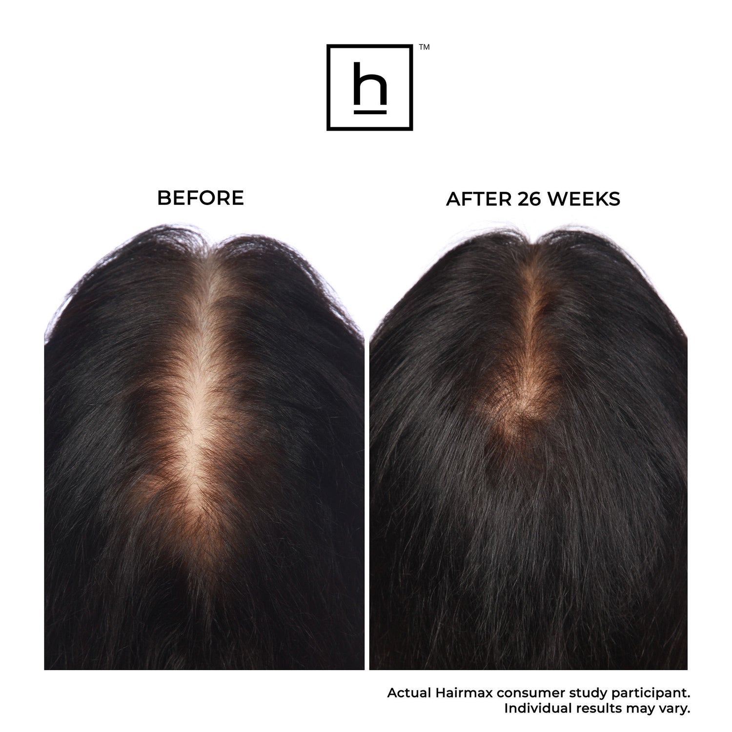 Before and after results of using HairMax Ultima 12 Hair Growth LaserComb