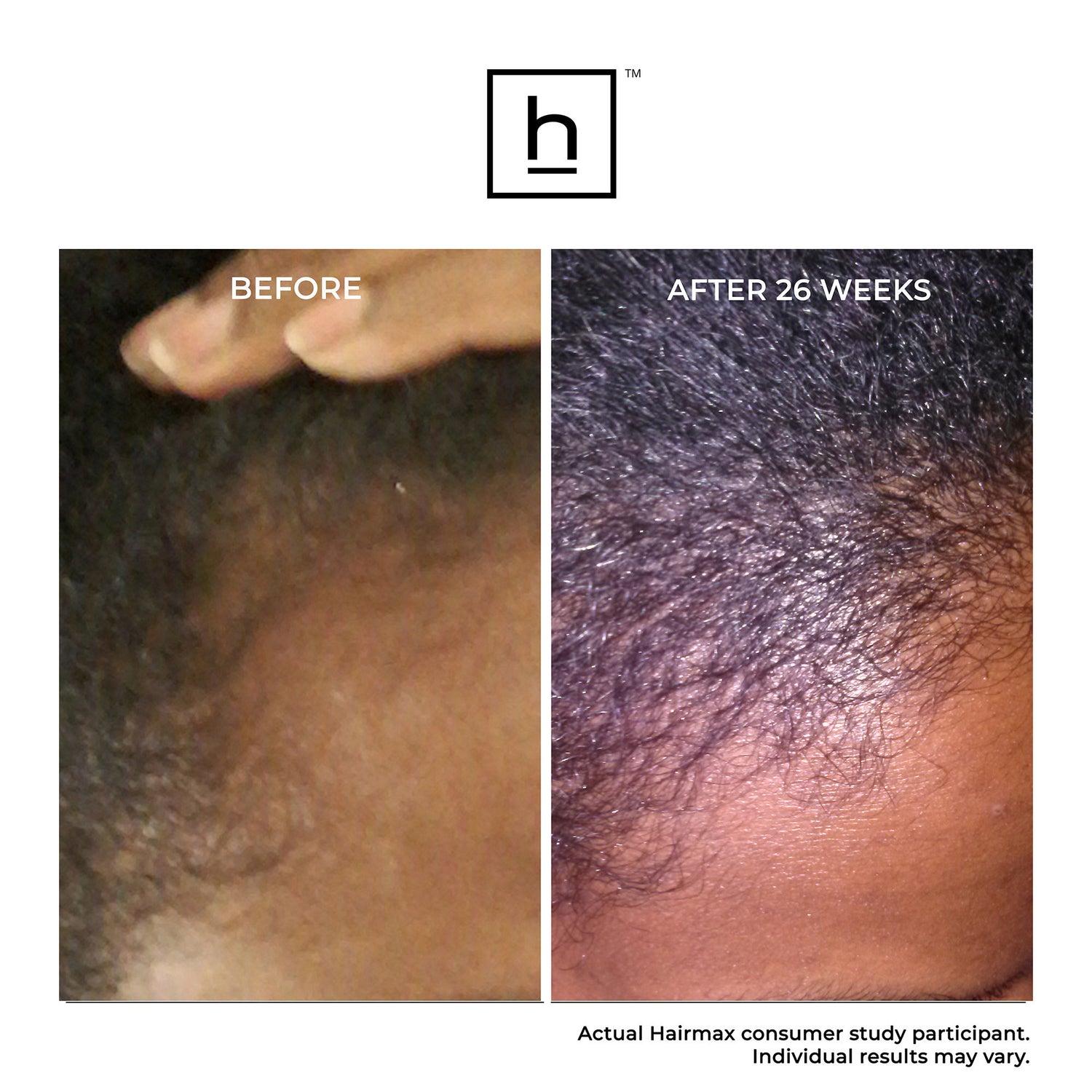 Before and after results of using HairMax Ultima 12 Hair Growth LaserComb