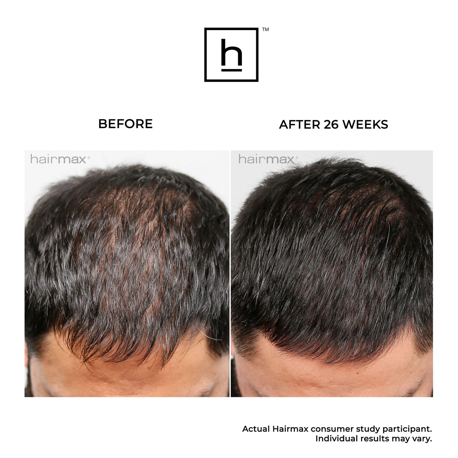 Before and after results of using HairMax Ultima 12 Hair Growth LaserComb