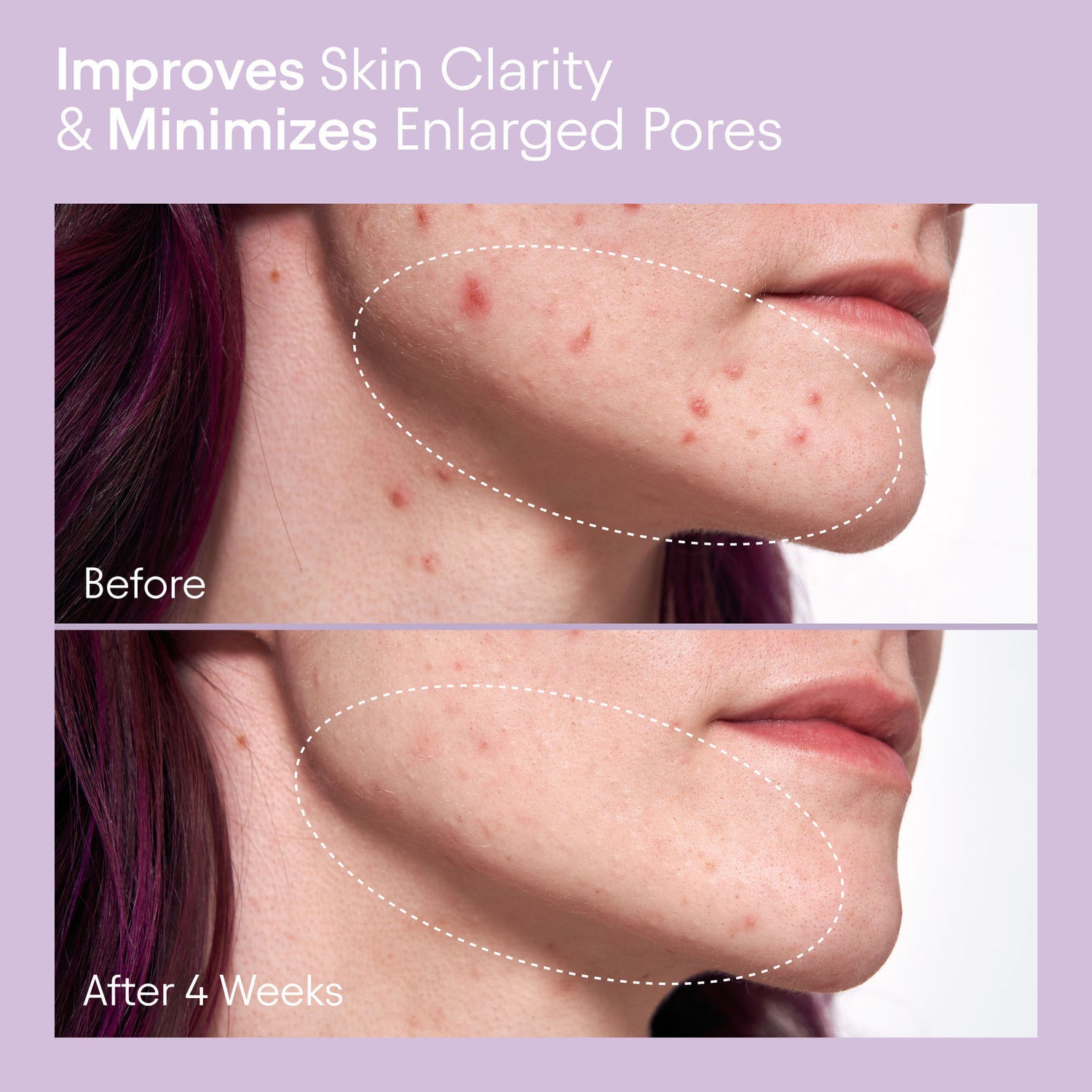 Before and after results of using Alpyn Beauty Pore Perfecting Liquid with 2% BHA and Borage